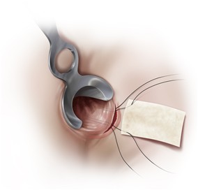 Cook® Biodesign® 4-Layer Tissue Graft