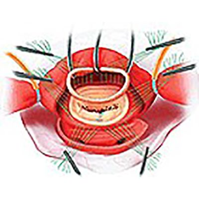 Péters Surgical Cardioflon® Sutures