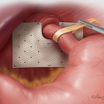 Cook® Biodesign® Hiatal Hernia Graft