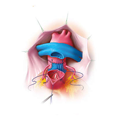 Péters Surgical Premio® Sutures