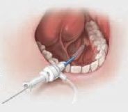 Cook® Sialendoscopy Kolenda Introducer Sheath