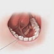 Cook® Sialendoscopy Wire Guide