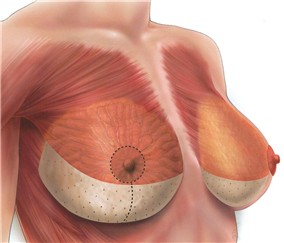 Cook® Biodesign® Plastic Surgery Matrix