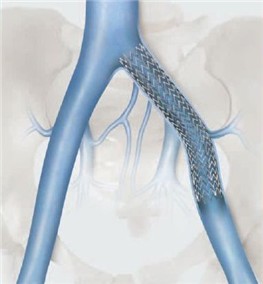 Cook® Zilver® Vena™ Venous Self Expanding Stent