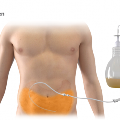 BD PeritX™ Peritoneal Catheter System