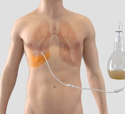 BD PleurX™ Pleural Catheter System